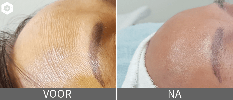 Resultaat micro-needling bij huidveroudering