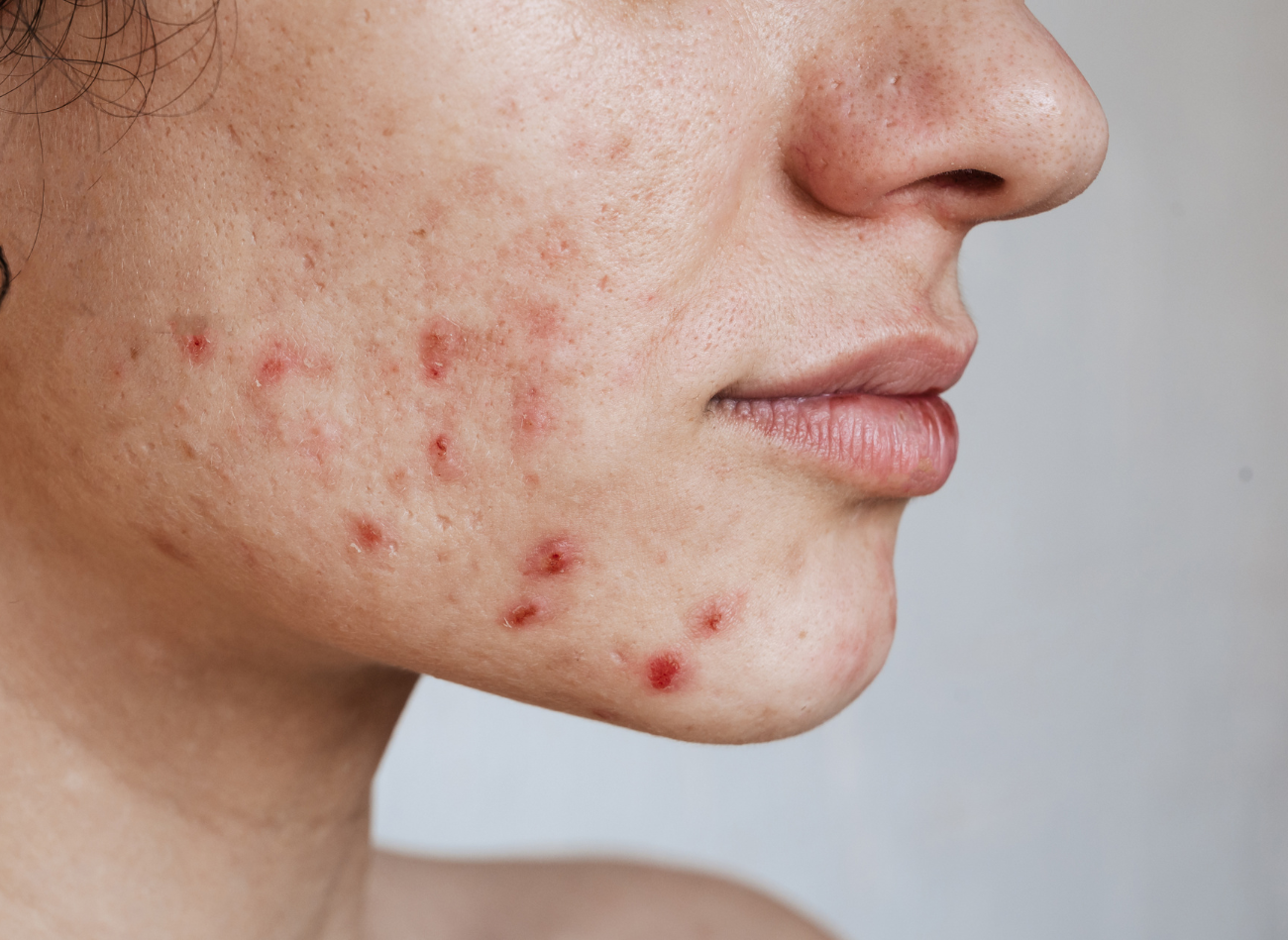 Acne: Hoe natuurlijke zuren helpen om de huidbalans te herstellen