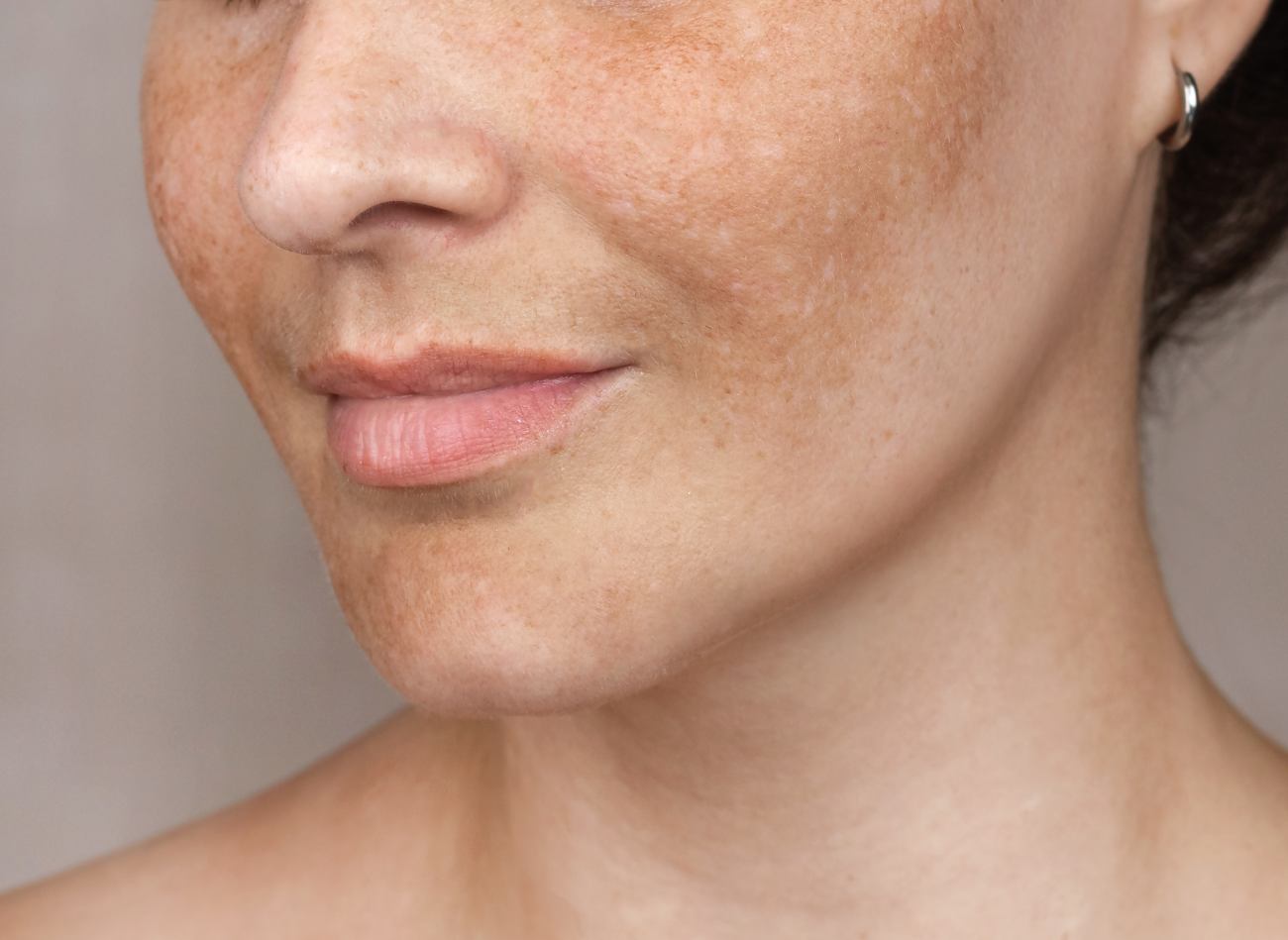 Melasma: De rol van chemische peelings