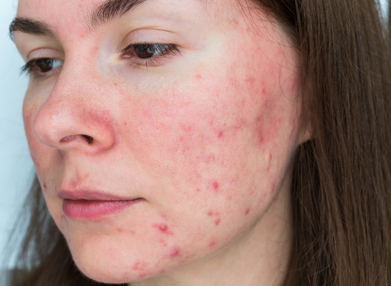 Rosacea: Is het mogelijk om het vuur te doven?