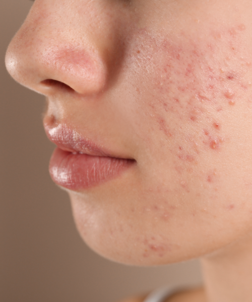 Acne Vulgaris