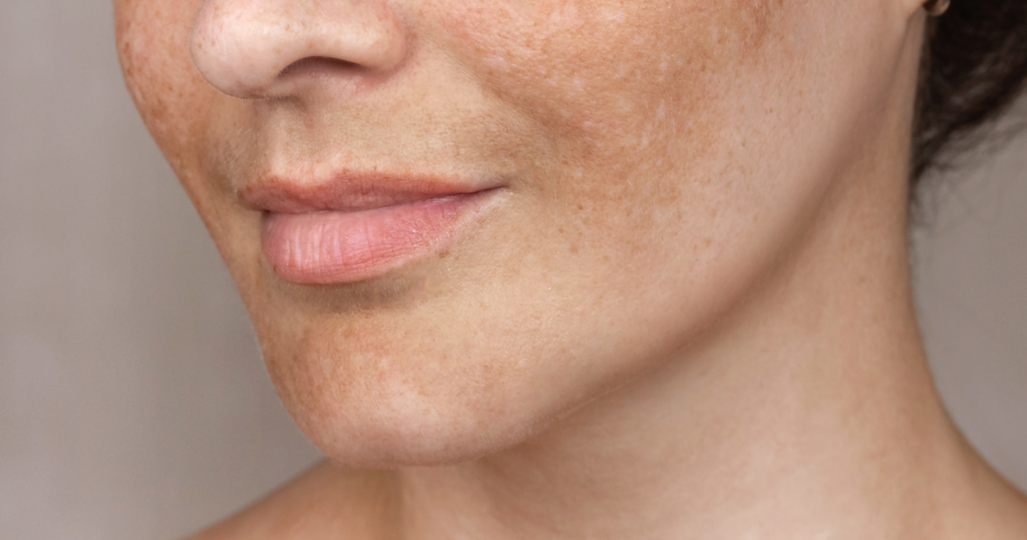 Melasma en chemische peelings