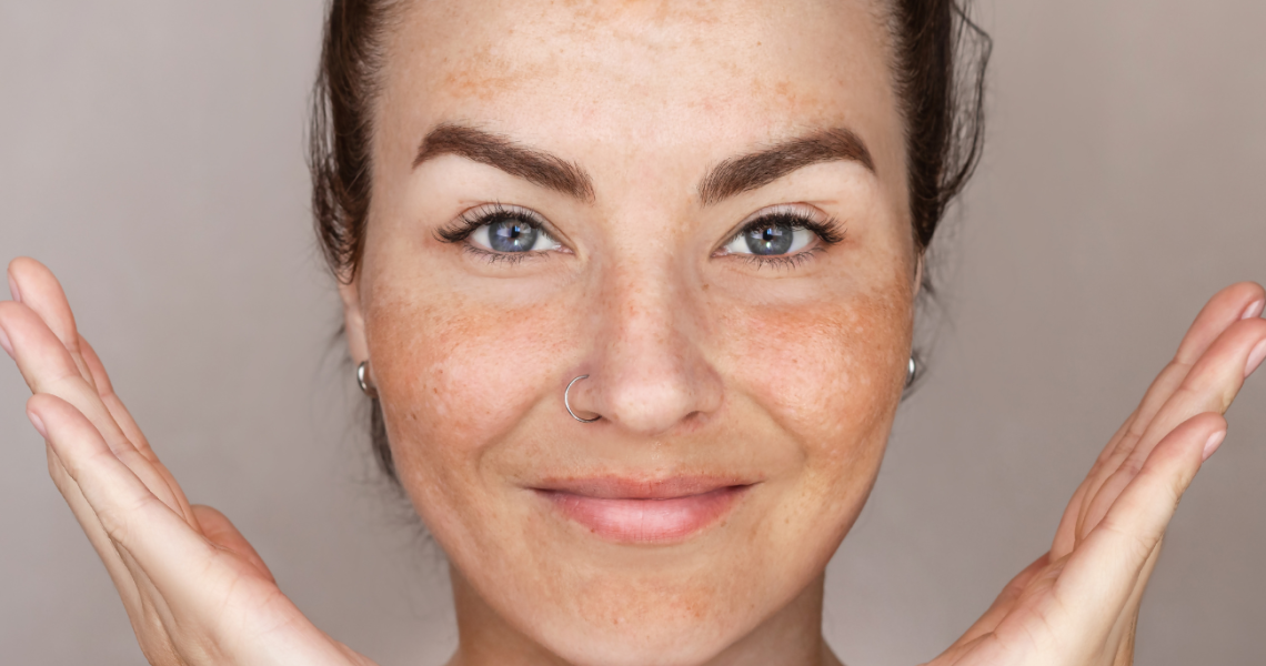 Melasma en microneedling