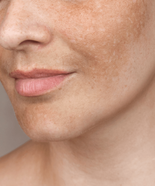 Melasma