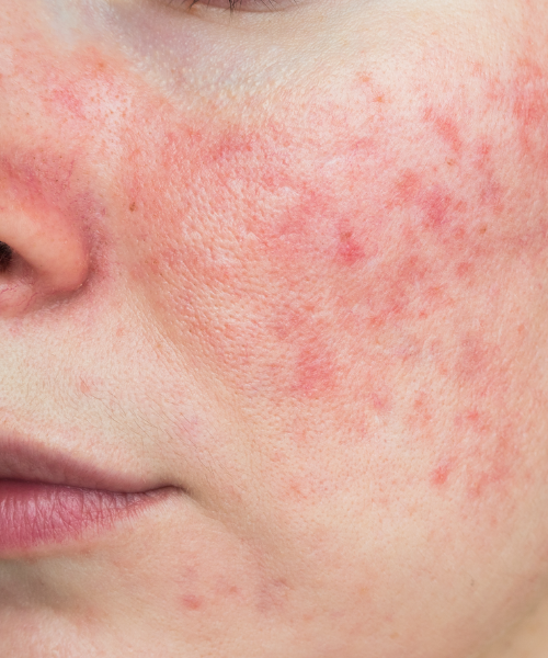 Rosacea