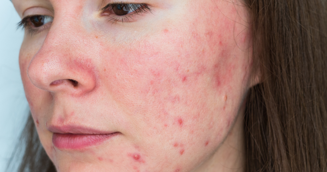 Rosacea