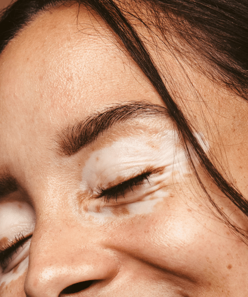 Vitiligo